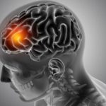 Waspada 5 Jenis Disabilitas yang digunakan Sering Dialami Pasien Stroke