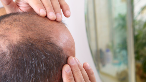 Alasan Mengapa Hair Transplant adalah Pilihan yang Tepat